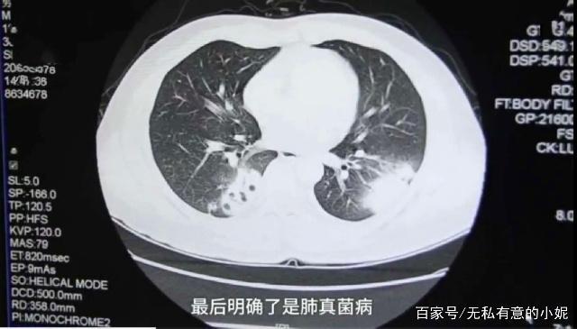 The doctor decided to do a lung puncture for further testing, and was astonished to find his lungs had been infected by fungus.[Screenshot from PearVideo report]